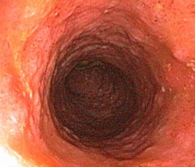 Endoscopic subscore 1 Endoscopic subscore 1