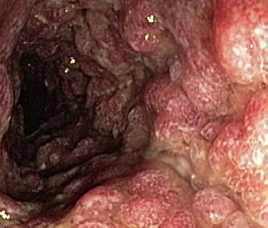 Endoscopic subscore 3 Endoscopic subscore 3