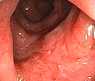 Endoscopic subscore 2 Endoscopic subscore 2