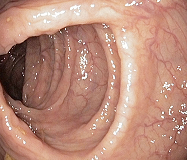 Endoscopic subscore 0 Endoscopic subscore 0